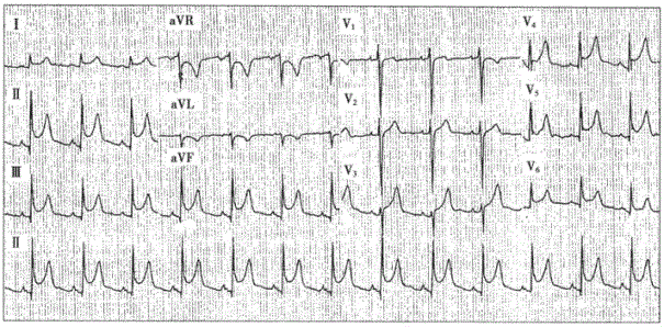 急性心包炎心电图表现图片