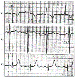 慢性肺心病心电图图片